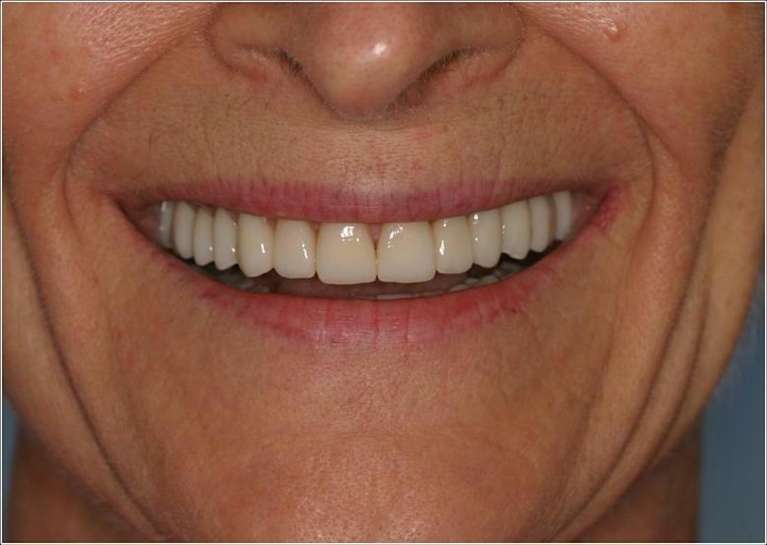 Full-Mouth-Reconstruction-After-Image