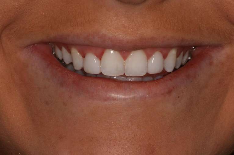 Implants-After-Image