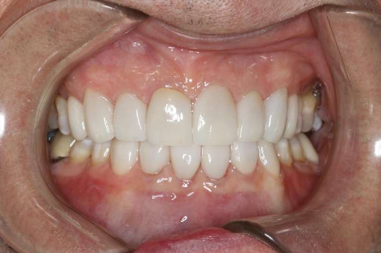 Implants-After-Image