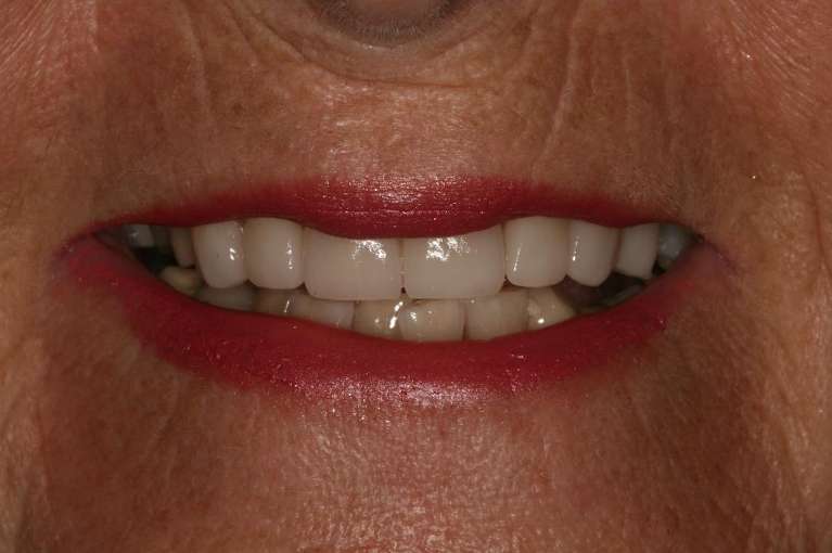 Teeth-Whitening-After-Image