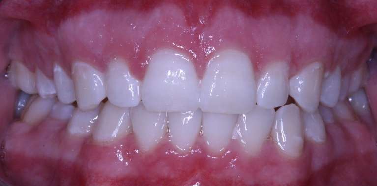 Teeth-Whitening-After-Image
