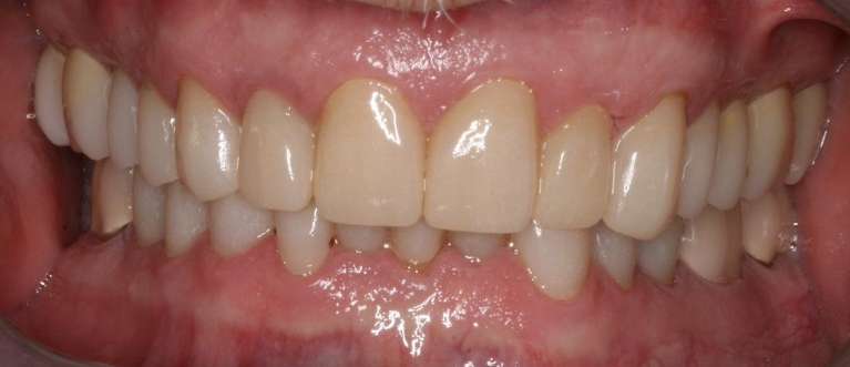 Full-Mouth-Reconstruction-After-Image