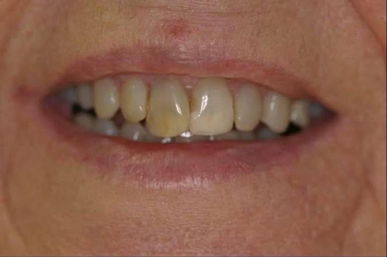 Veneers-Before-Image