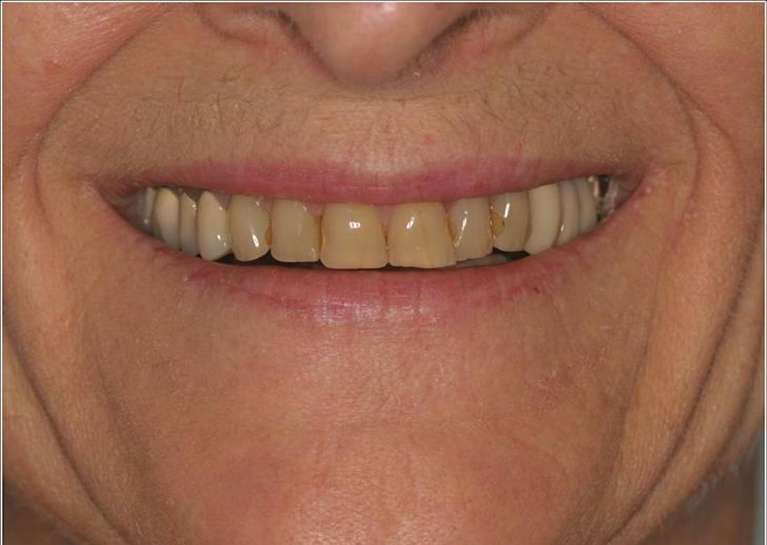 Full-Mouth-Reconstruction-Before-Image
