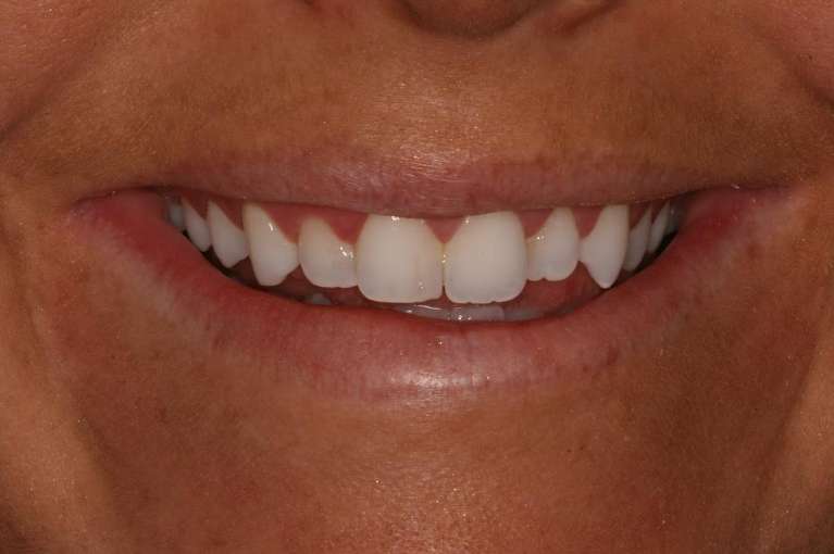 Implants-Before-Image