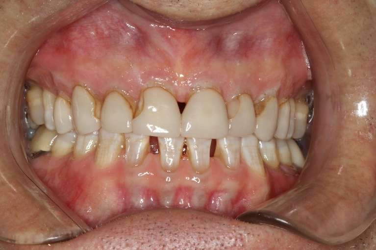 Implants-Before-Image