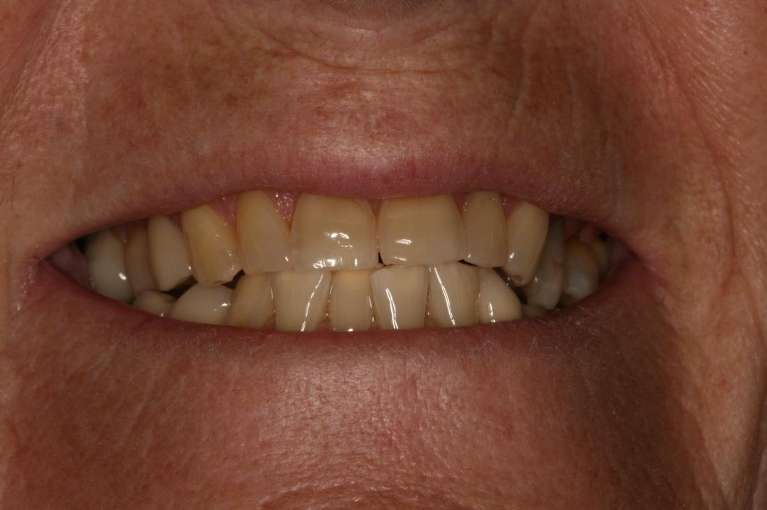 Teeth-Whitening-Before-Image