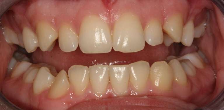Teeth-Whitening-Before-Image